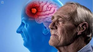 Cinco preguntas sobre el nuevo fármaco para el Alzheimer: a qué pacientes está destinado y cuáles son sus beneficios
